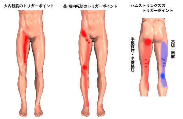 大腿部の筋のトリガーポイント